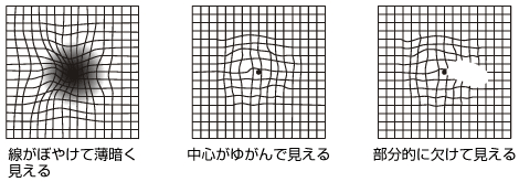 加齢黄斑変性症