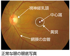 加齢黄斑変性症