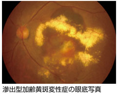 加齢黄斑変性症