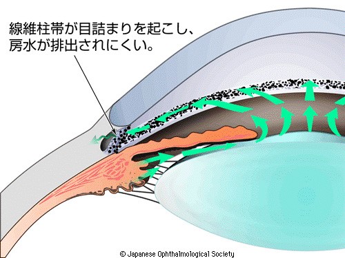 原発開放隅角緑内障