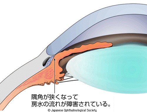 原発閉塞隅角緑内障