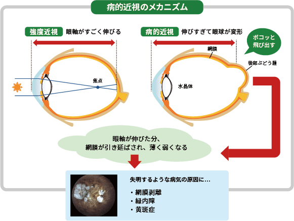 眼軸長と近視
