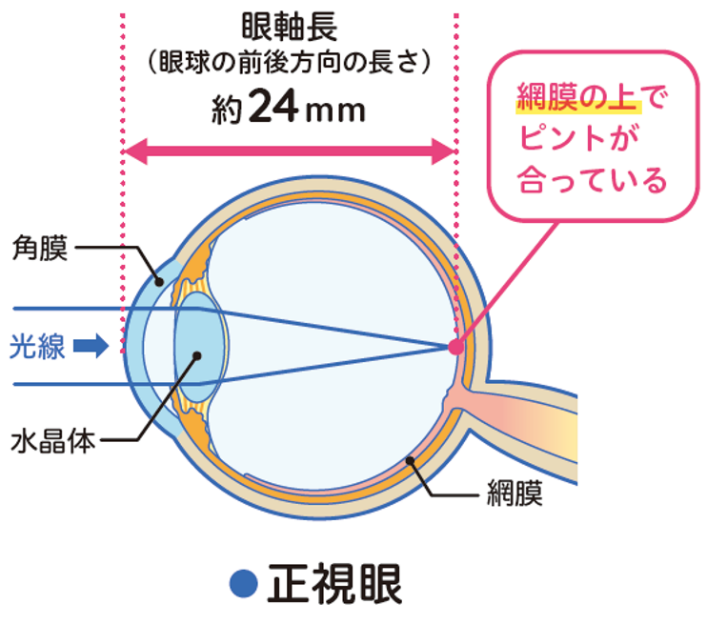 眼軸長と近視