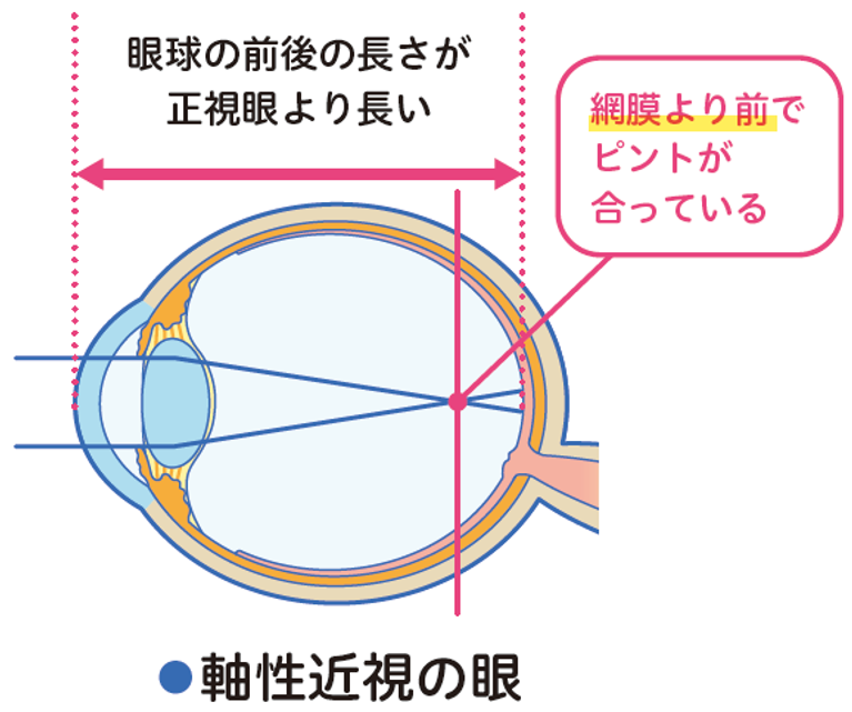 眼軸長と近視