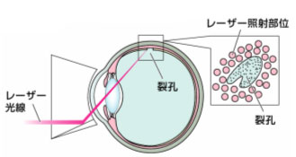 網膜光凝固術