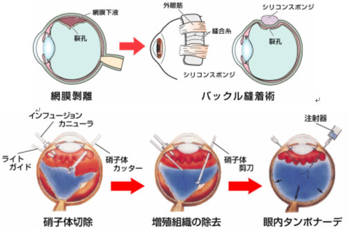 網膜硝子体手術