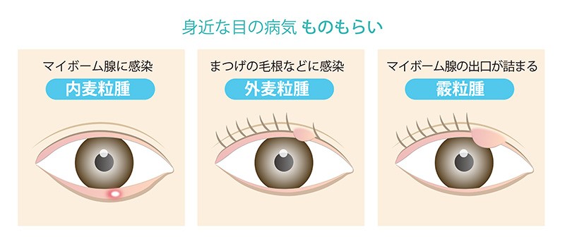 霰粒腫、麦粒腫