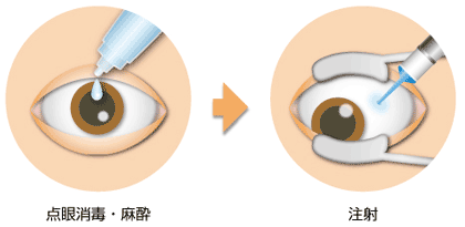 加齢黄斑変性症