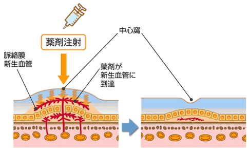 加齢黄斑変性症
