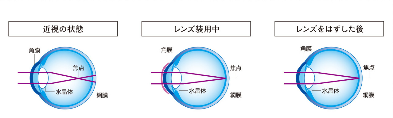 オルソケラトロジー