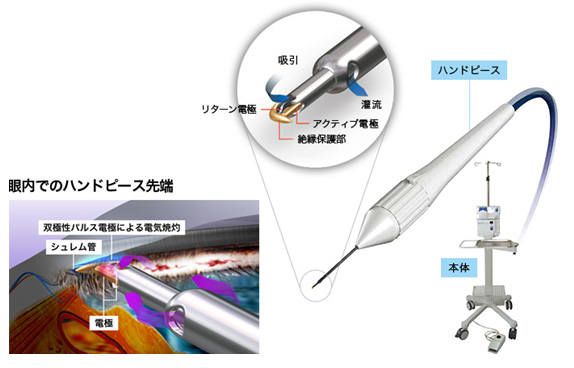 流出路再建術（トラベクトーム）