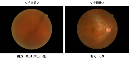 網膜硝子体手術