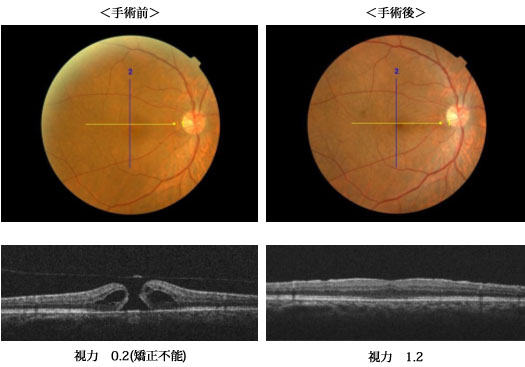 網膜硝子体手術